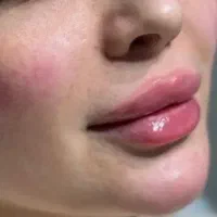 ژل و بوتاکس