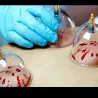 حجامت ،بادکش در منزل هزینه ایاب و ذهاب  رایگان