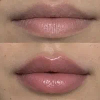 فیلر تخصصی لب