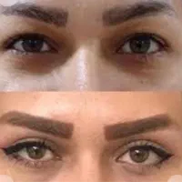 بلفارو،دایرکت ابرو،میدفیس،ساکشن اقساطی