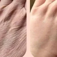 تزریق تخصصی فیلر بادی