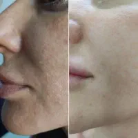 کرم ویتامین سی بیوممتیک / ضدلک/ روشن کننده