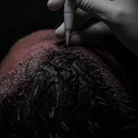 کاشت مو و ابرو تضمینی