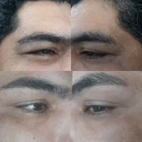 اموزش رایگان بوتاکس زیر بغل