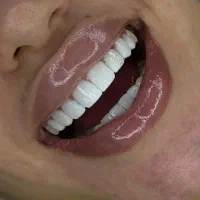 عصب کشی/کامپوزیت/لمینیت/درمانی