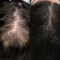 پایان دادن به کچلی