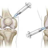درمان آرتروز و رماتیسم مفصل در منزل ژل/کورتون/PRP