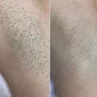 لاغری با کرایو لیزر شاتی الکساندرایت لیفت سینه