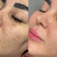 لکه هاتو تضمینی محو کن