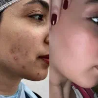 فیشیال تخصصی پوست و جوانسازی بانوان و آقایان