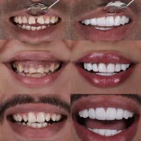 کامپوزیت/لمینت/دندانپزشکی
