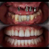 ایمپلنت دندان اقساط ۶تا۱۸ماه دندانپزشکی کامپوزیت