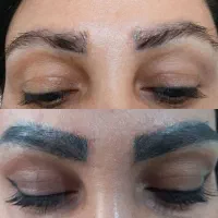 خدمات ریمو (پاک کردن) تتوهای قدیمی زیر نظرنظر پزشک