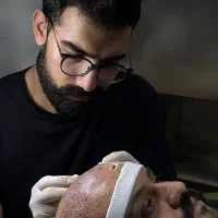 متخصص کاشت مو با خط رویش کاملا طبیعی در ولیعصر