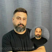 پروتز موی مردانه اصفهان بدون جراحی ترمیم پروتز