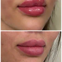 تزریق ژل و بوتاکس و جوانساز