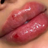 آف هفتگی ژل وبوتاکس وجوانساز