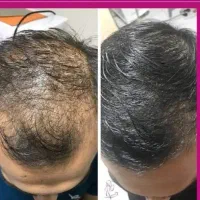 معجزه موهات بدون جراحی