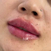 فیلر تخصصی لب