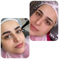 میکروبلیدینگ و شیدینگ اقساطی