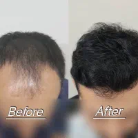 کاشت مو با ضمانت فول تراکم در شیراز