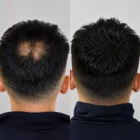 برترین روش برای کم پشتی