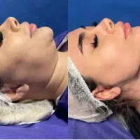 ساکشن غبغب و‌بوکال فت بدون جراحی