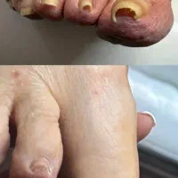 خارج کردن ناخن از داخل گوشت  و نصب ارتونیل