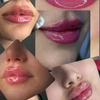 بوتاکس به مدت محدود۹۹۰،تخفیف ویژه پک ۱۰cc فول فیس