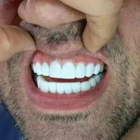 کامپوزیت. دندان مصنوعی