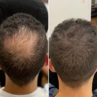 تتو اسکالپ کف سر