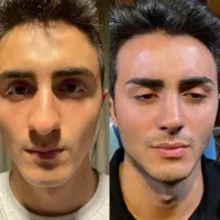عمل زیبایی بینی و ترمیم