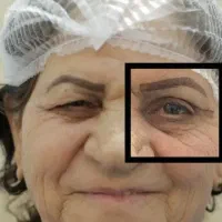رفع افتادگی پلک (جراحی زیبایی)بامتداد foxeye