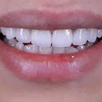 دندانسازی ،دندان مصنوعی لمینت