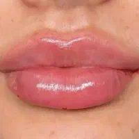 تزریق ژل،بوتاکس،مزوژل و خدمات زیبایی توسط پزشک