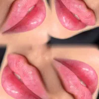 تزریق ژل لب جشنواره پاییزه فیلر زاویه سازی بوتاکس