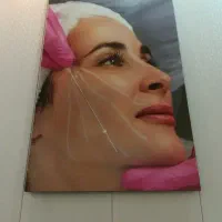 جراحی بلفارو پلاستی