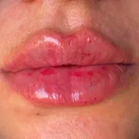 ژل و بوتاکس