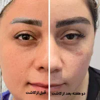 اصلاح فرم و تراکم ابرو (کاشت ابرو)