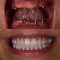 جشنواره ویژه دندانپزشکی و ایمپلنت