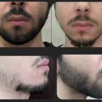 زیر ۳۰روز. ریشو موهاتو. پرپشت. کن