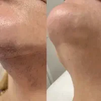 تخفیف دستگاه hair removal لیدی ویژه جلسه اولی ها
