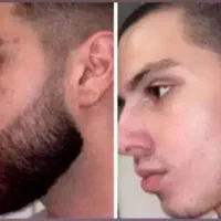 پک رویش مجدد ریش