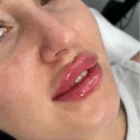 ژل ،بوتاکس ، جوانسازی و رفع جای جوش و لک