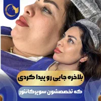 آف 50% ساکشن غبغب سوپر کانتور VLine بدون عمل جراحی