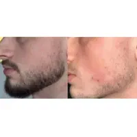 دیگه مَرده و ریشش
