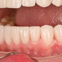 شرایط اقساطی ویژه ایمپلنت کره