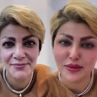 خدمات توسط متخصص فیلر فول فیس گونه زیر چشم اف ۷۰٪
