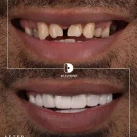 عصب کشی ونیر کامپوزیت کشیدن ترمیم ایمپلنت