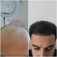 کاشت مو با نتیجه طبیعی